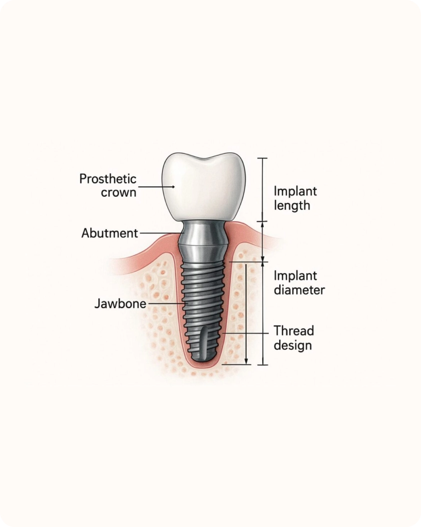 Dental implant diagram showing prosthetic crown, abutment, implant post, and jawbone